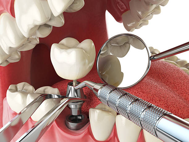 Best Emergency Wisdom Teeth Removal in Cabin John, MD